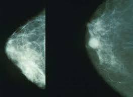 Targeting breast cancer metabolism indian bureaucracy