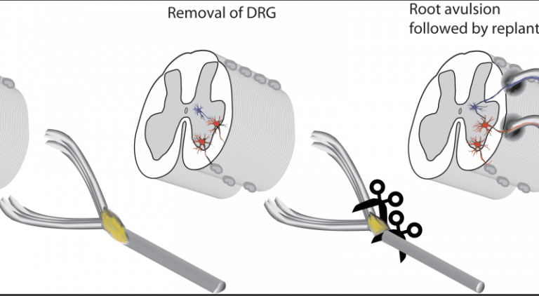 New surgical strategy offers hope for repairing spinal injuries