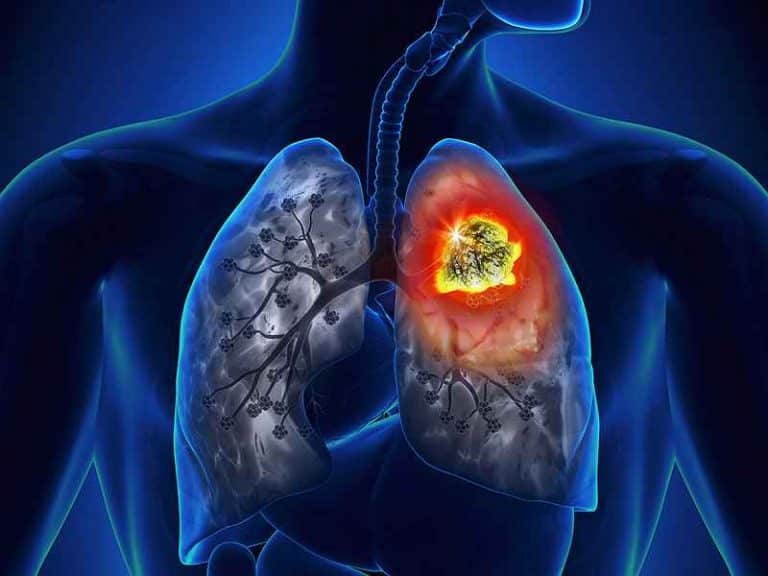 Artificial intelligence can determine lung cancer type