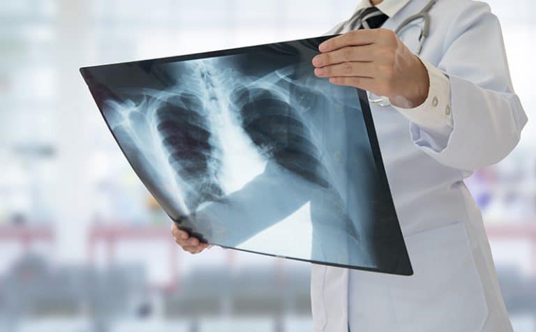 Scientists developing new vaccine strategy for tuberculosis