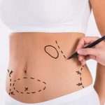 No increase in complications with 'tummy tuck' in obese patients
