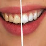 Teeth whitening products can harm protein-rich tooth layer