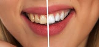 Teeth whitening products can harm protein-rich tooth layer