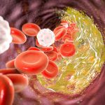 How 'bad cholesterol' enters artery walls