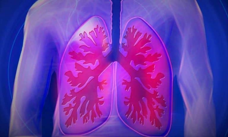 Lung cancer under-recognized in people who have never smoked
