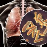 In cystic fibrosis, lungs feed deadly bacteria