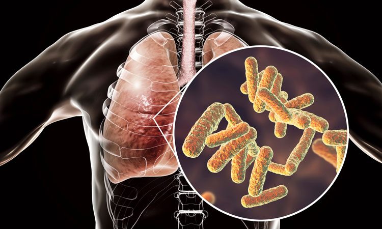 In cystic fibrosis, lungs feed deadly bacteria