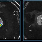 A new route to blocking children bone cancer