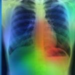 AI system accurately detects key findings in chest X-rays of pneumonia patients within 10 seconds