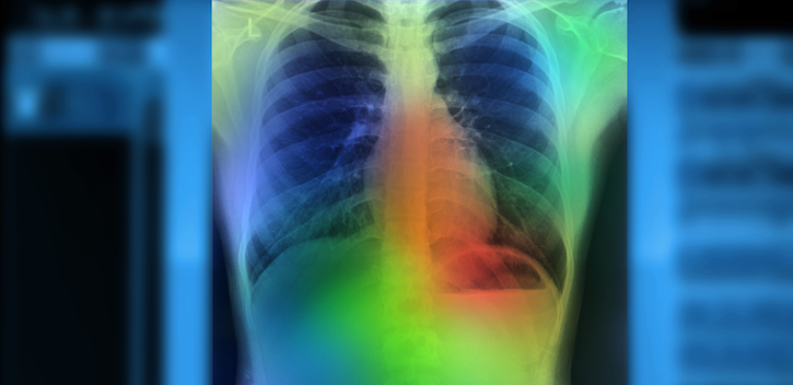 AI system accurately detects key findings in chest X-rays of pneumonia patients within 10 seconds