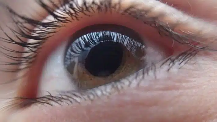Another reason to get cataract surgery It can make you 48% safer on the road