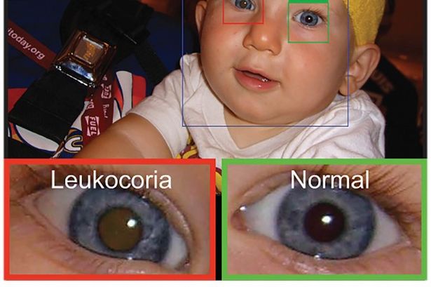 Prototype smartphone app can help parents detect early signs of eye disorders in children