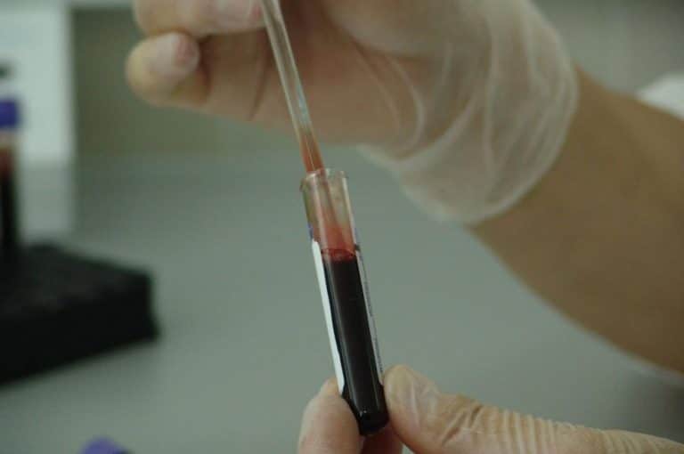 Second patient has been cured of HIV, study suggests