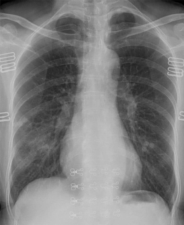 Statement on chest imaging and COVID-19