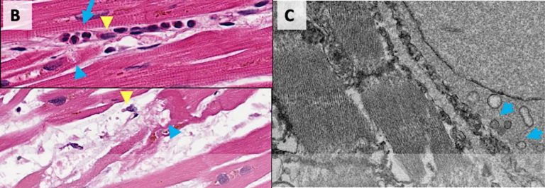 Autopsies reveal surprising cardiac changes in COVID-19 patients