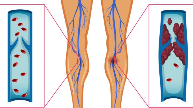 Dangerous blood clots form in leg arteries of COVID-19 patients