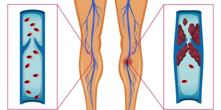 Dangerous blood clots form in leg arteries of COVID-19 patients