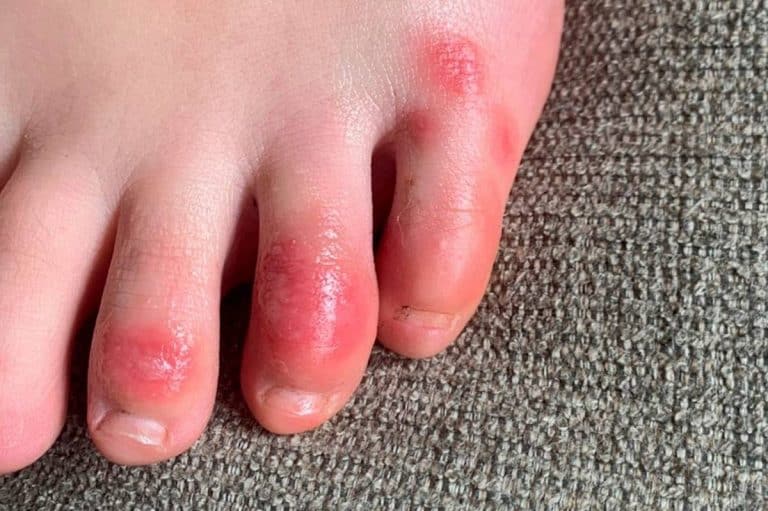 Study supports link between COVID-19 and 'COVID Toes'