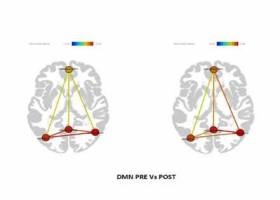 Mild Cognitive Impairment