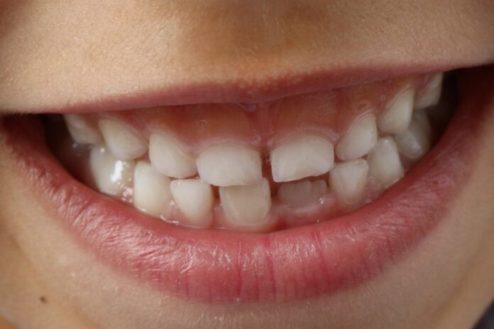 Baby teeth